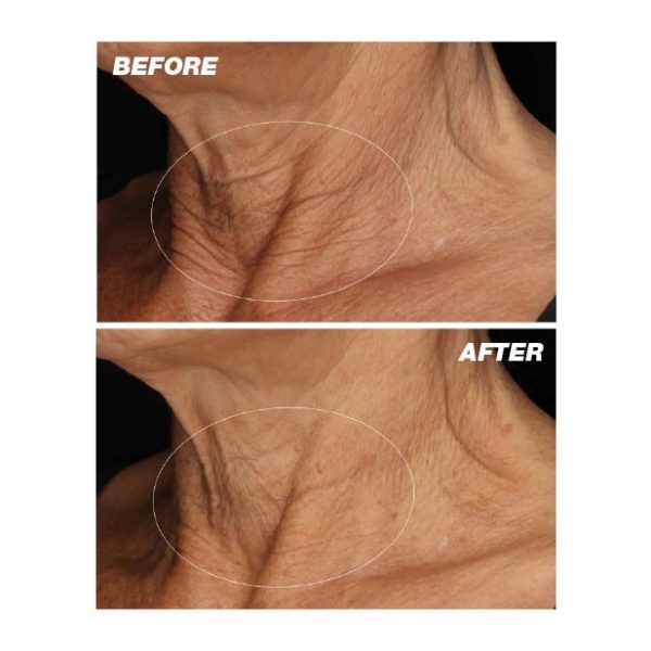 dermalogica neck fit contour serum (results)